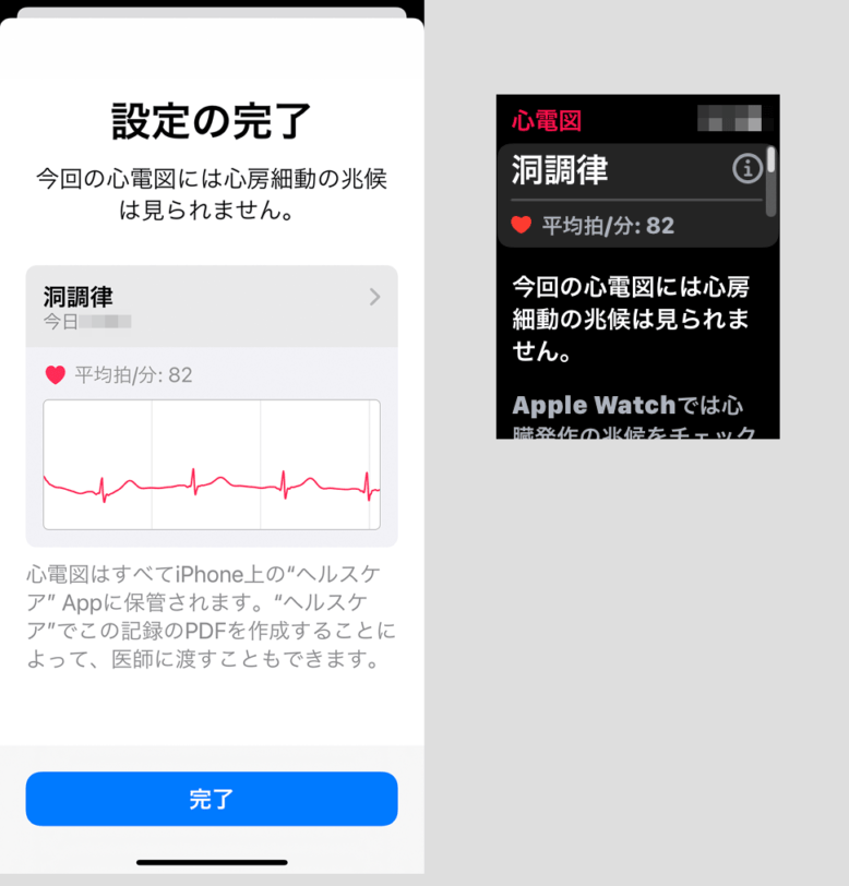 心電図APP　洞調律